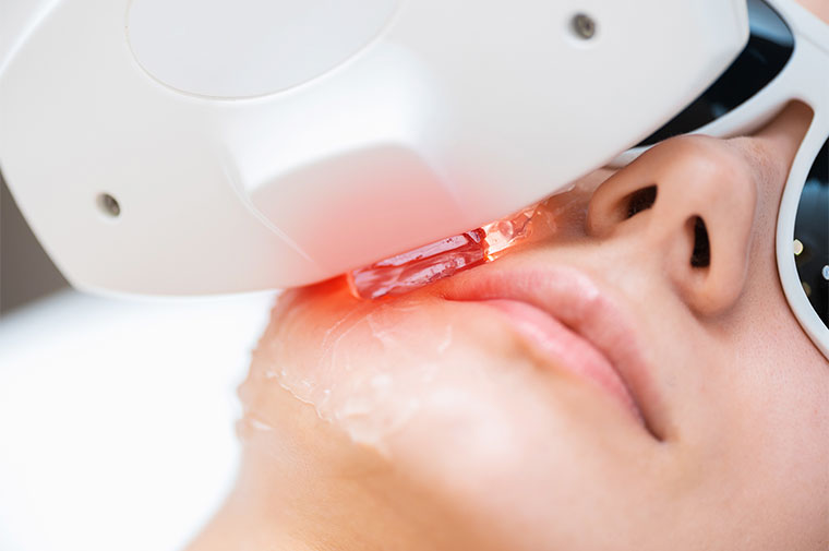 Na imagem, uma mulher realizando tratamento com laser fracionado